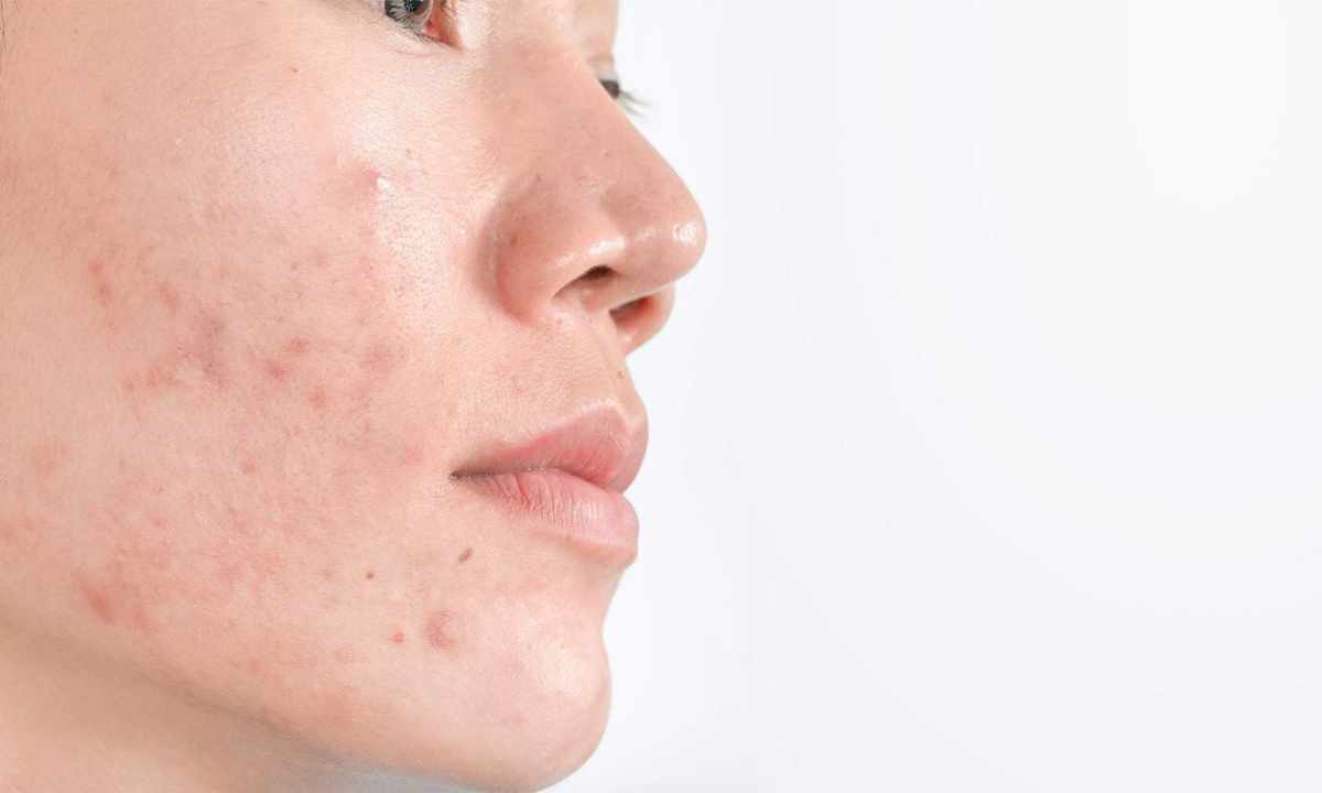 How to get rid of pigmental spots on face
