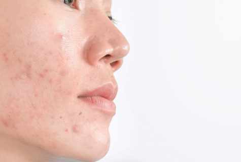 How to get rid of pigmental spots on face