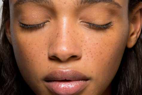 How to get rid of freckles forever