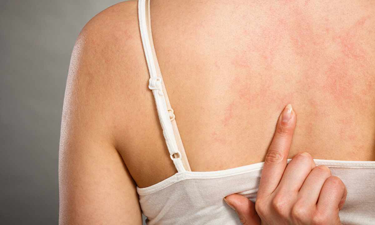 How to get rid of rashes on skin
