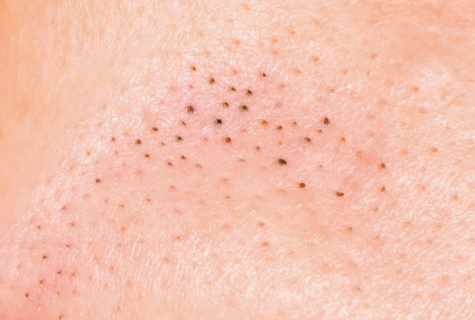 How to get rid of black dots on skin