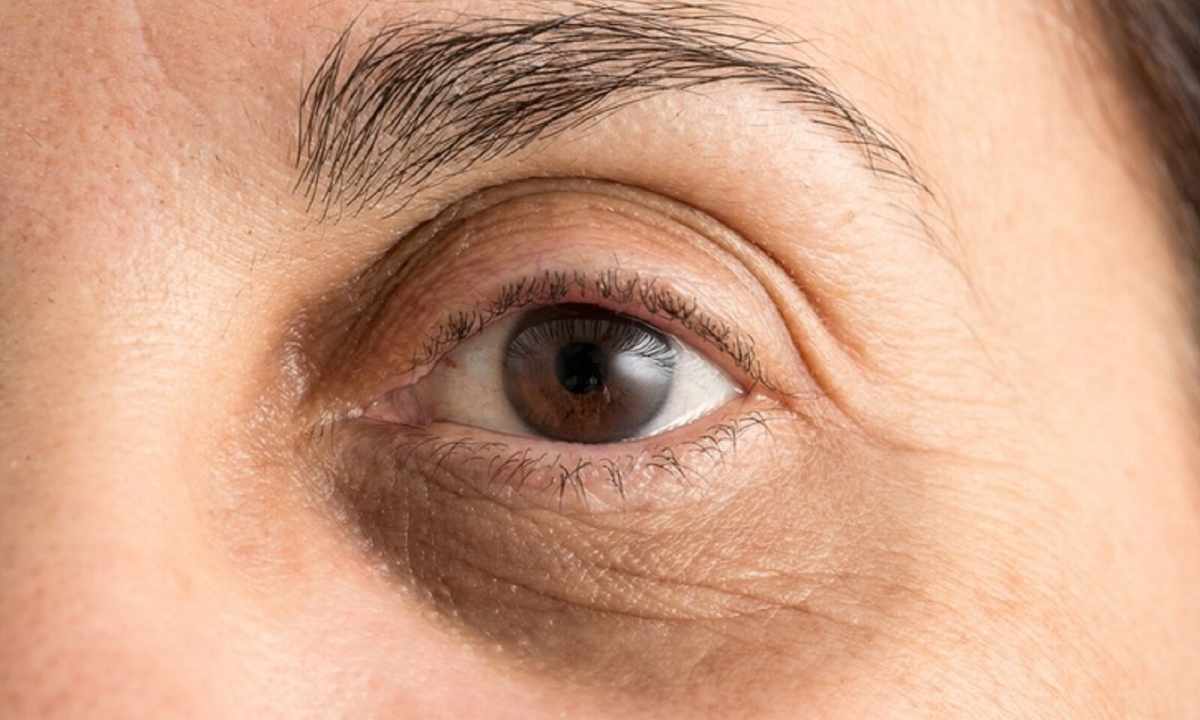 How to remove yellow circles under eyes