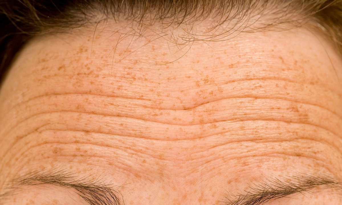 How to smooth wrinkles on forehead