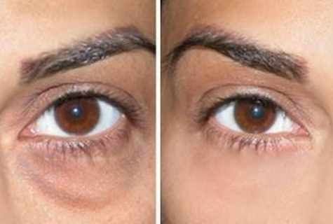 How to get rid of circles and bags under eyes