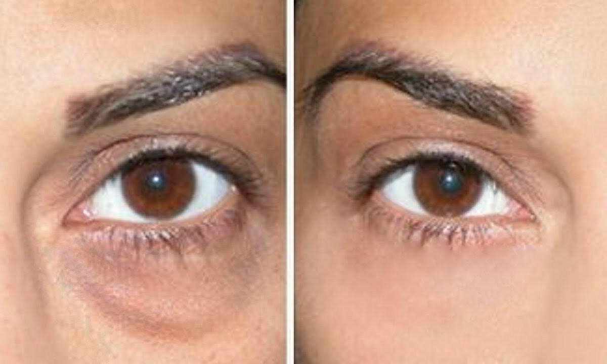 How to remove bags under eyes