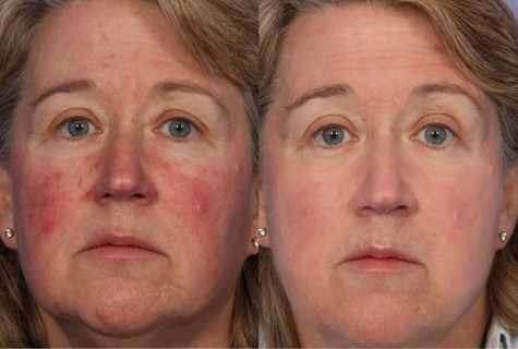Rozatsea on face: treatment by folk remedies