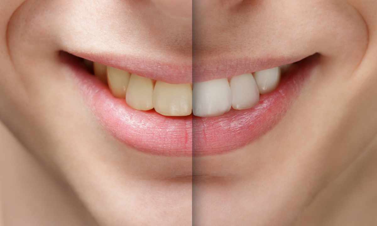 Safe ways of bleaching of teeth