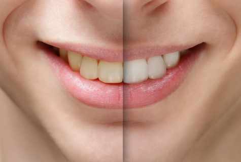 Safe ways of bleaching of teeth