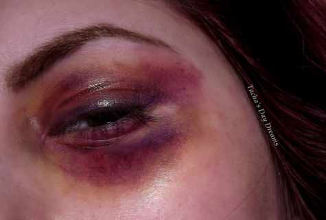 What to do if under eyes bruises