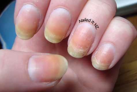 Why nails turn yellow