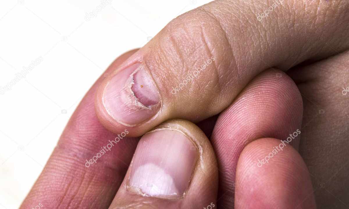 The reasons of emergence of ""edges"" on nails