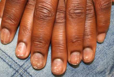 How to get rid of spots on nails