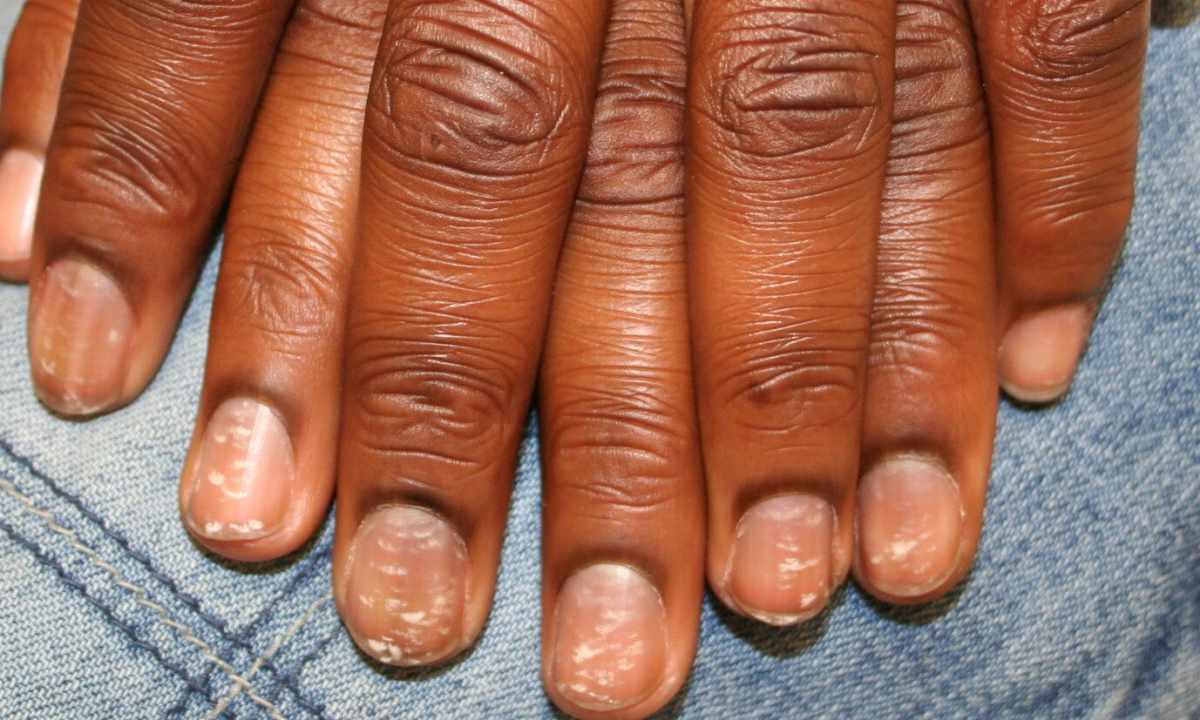 How to get rid of white spots on nails