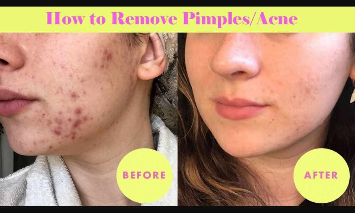How to remove pimples on bottom