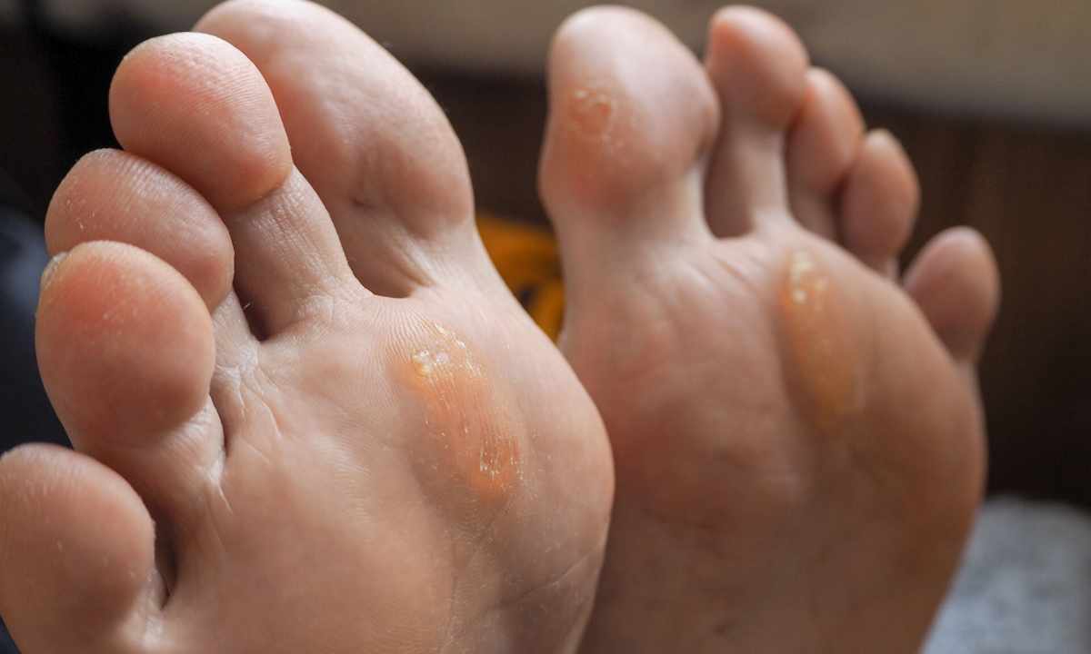 How to remove callosities on toes