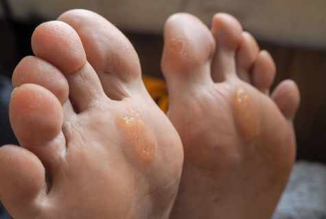 How to remove callosities on toes