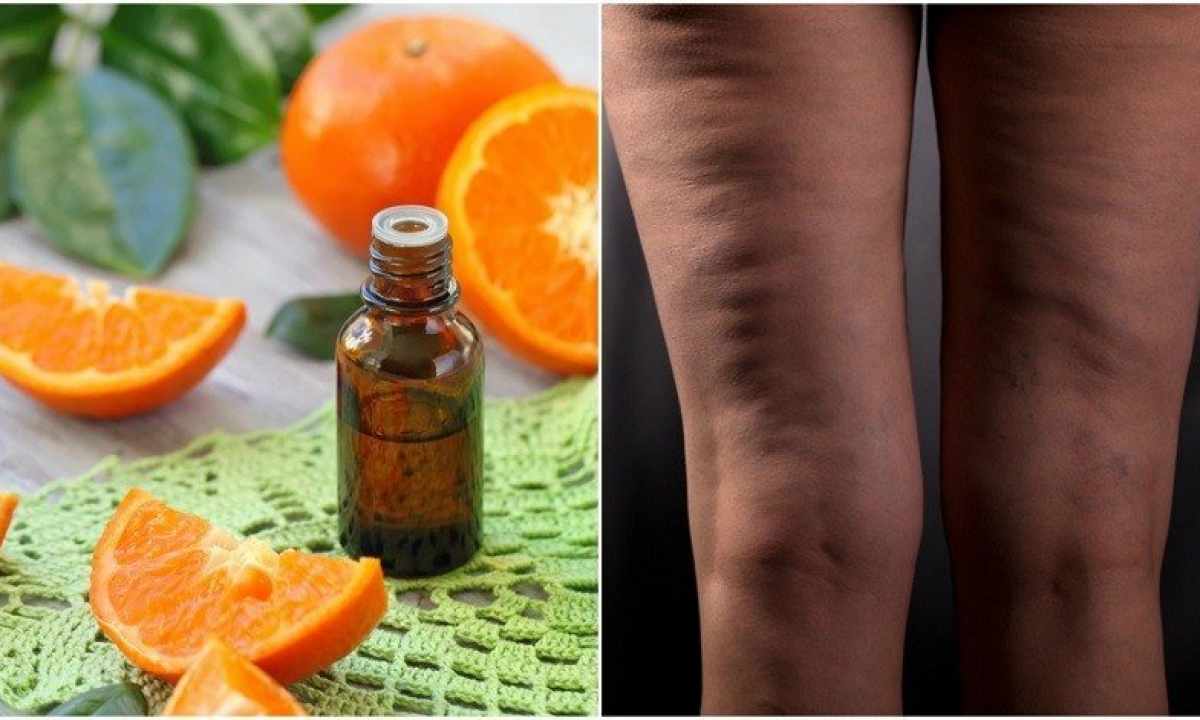 What essential oils will help to get rid of cellulitis