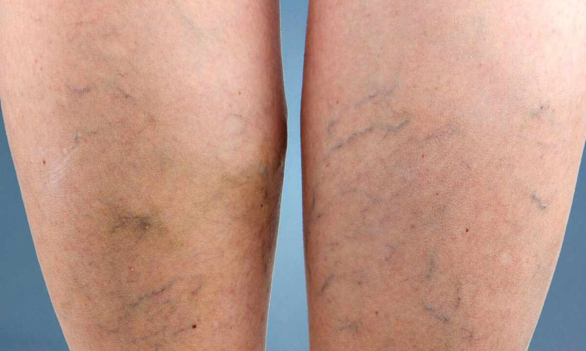 How to get rid of vascular asterisks standing
