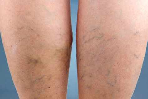 How to get rid of vascular asterisks standing