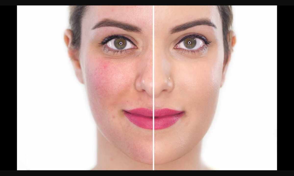 How to remove redness of skin
