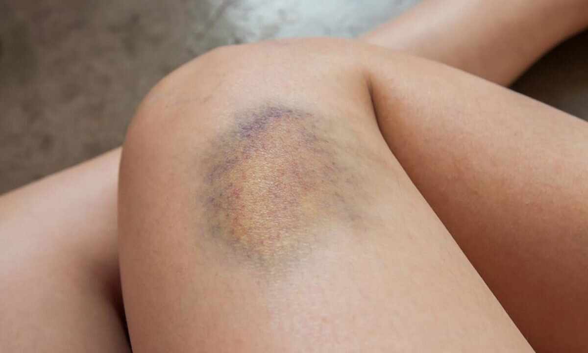 How to remove quickly bruise