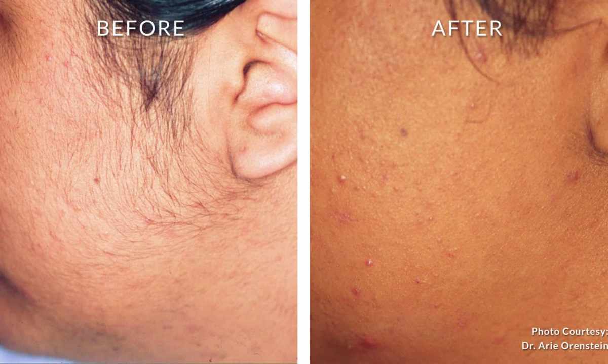 How to look after skin after laser epilation