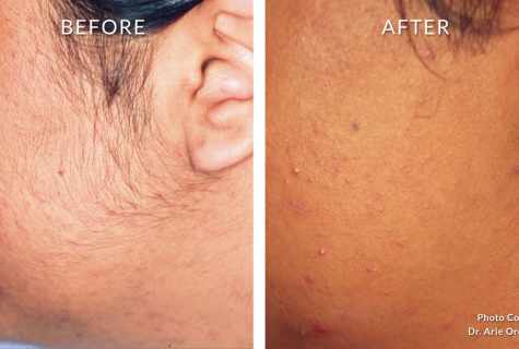 How to look after skin after laser epilation
