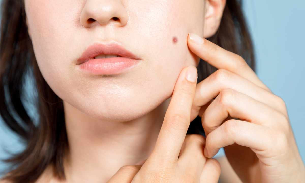 How to get rid of pimples on hands