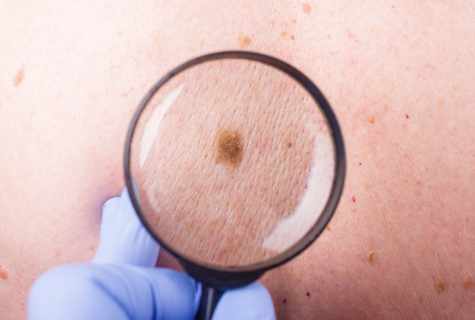 How to prevent emergence of birthmarks