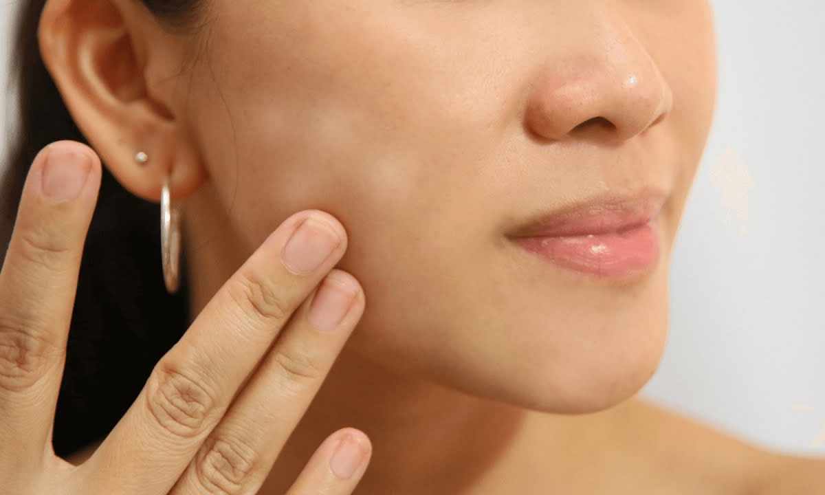 How to get rid of white spots on skin