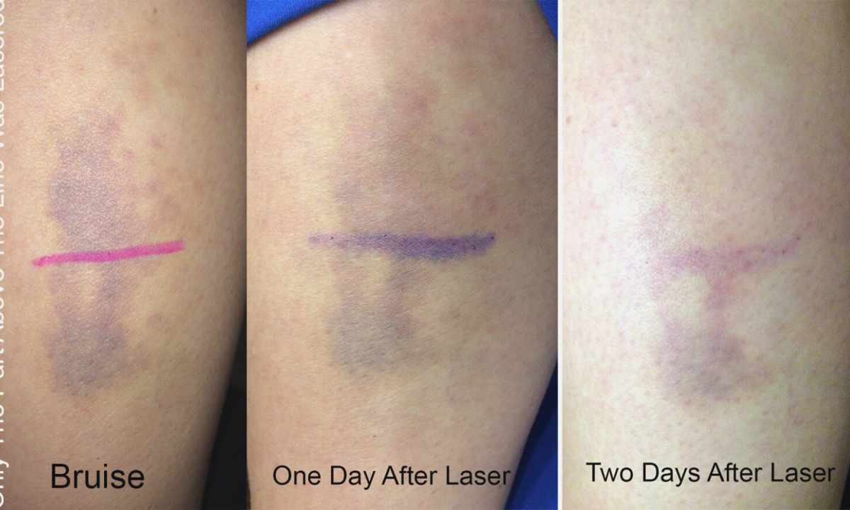 How to remove hypostases and bruises