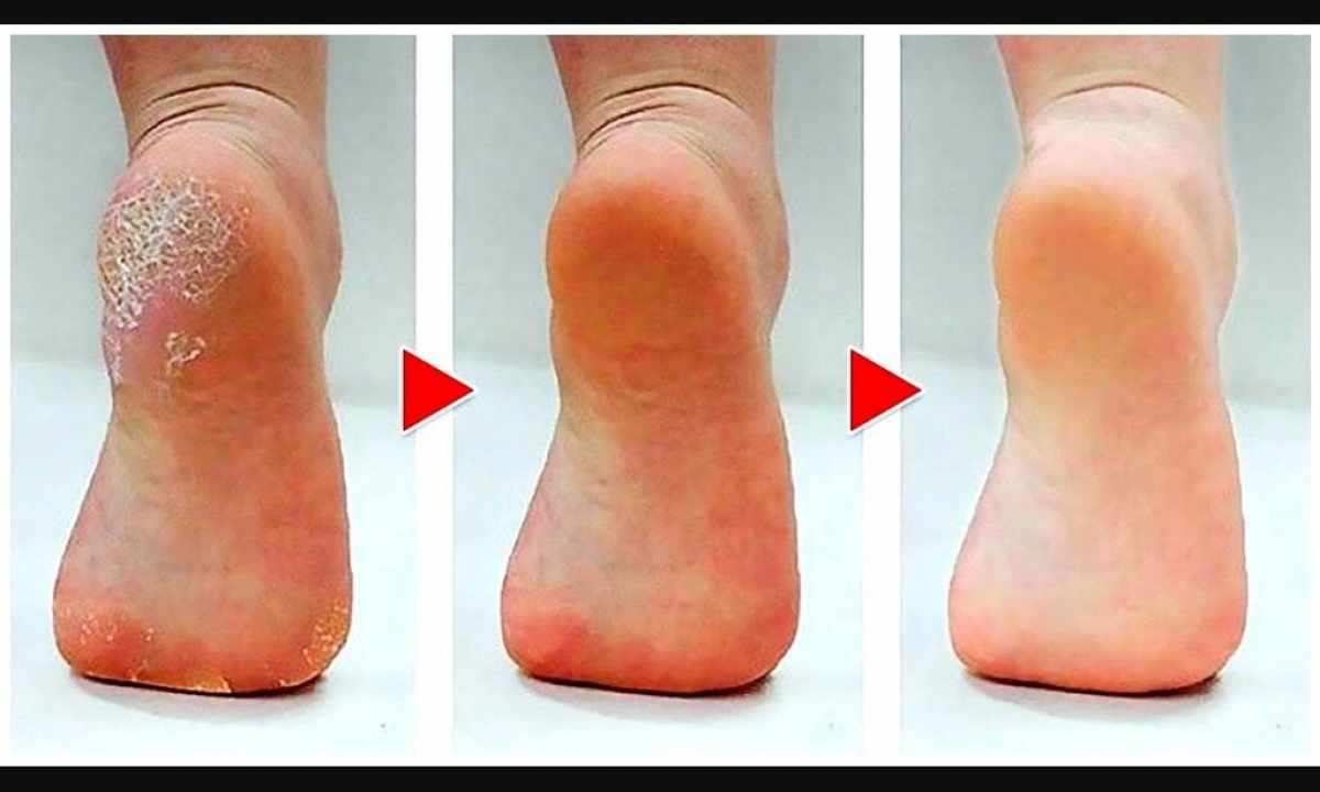 How to get rid of dryness of heels