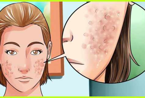 How to get rid of pimples on back and face