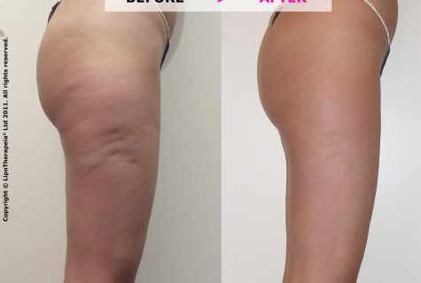 How to remove cellulitis? Efficiency of wrapping