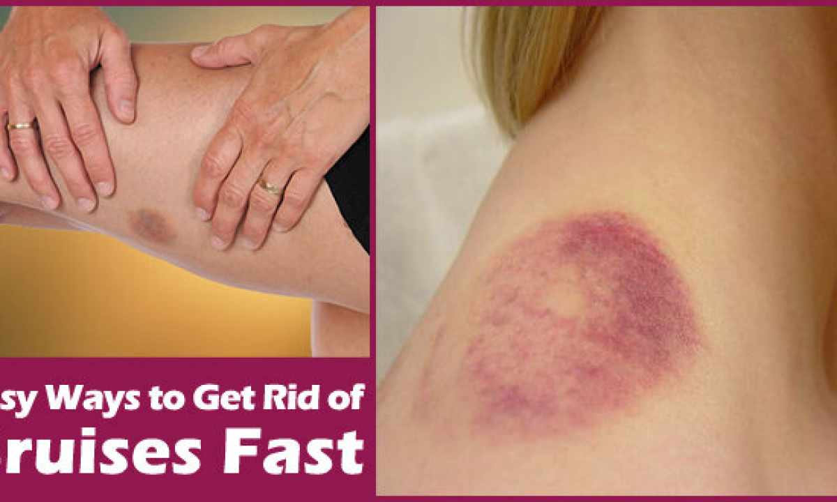 How to get rid of bruises from pricks