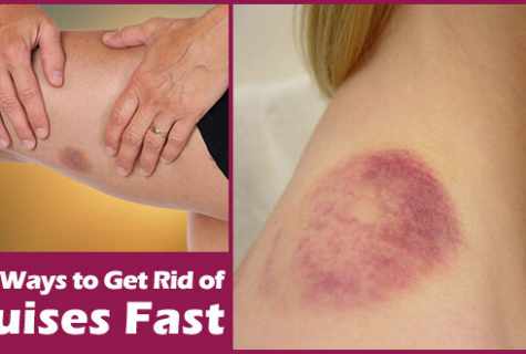 How to get rid of bruises from pricks