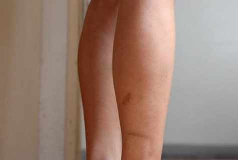How to remove scar on leg