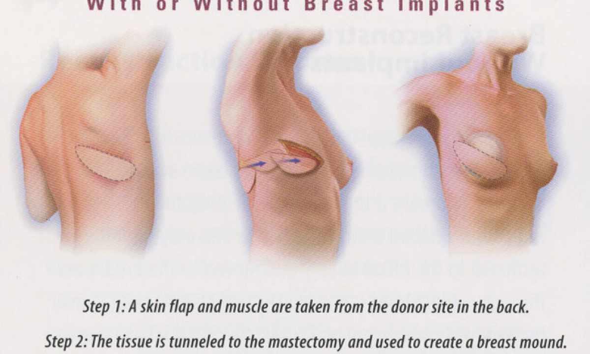 How to increase breast without plastic surgeries