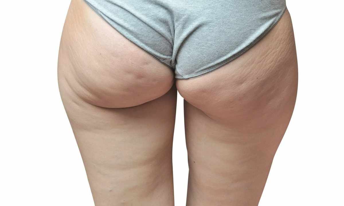 How to get rid of cellulitis on buttocks