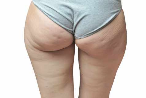 How to get rid of cellulitis on buttocks