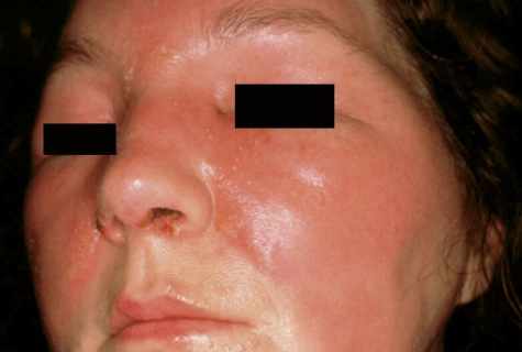 How to define appearance of cellulitis