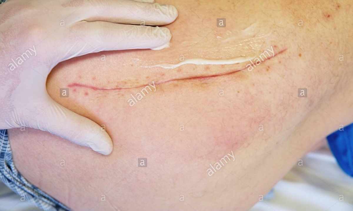 Removal of fatty tumor on body