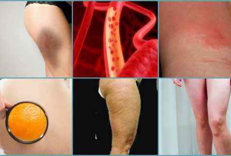 How to reduce cellulitis in month in house conditions