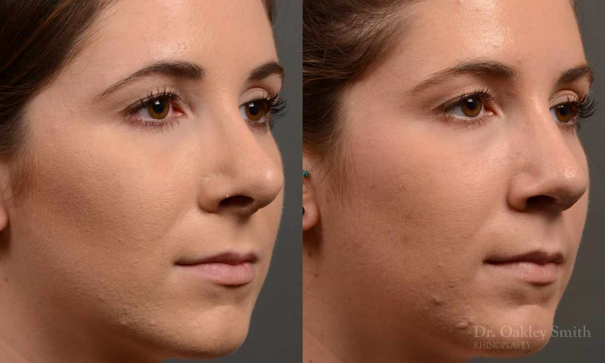 How to reduce the nose size