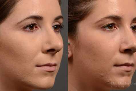 How to reduce the nose size
