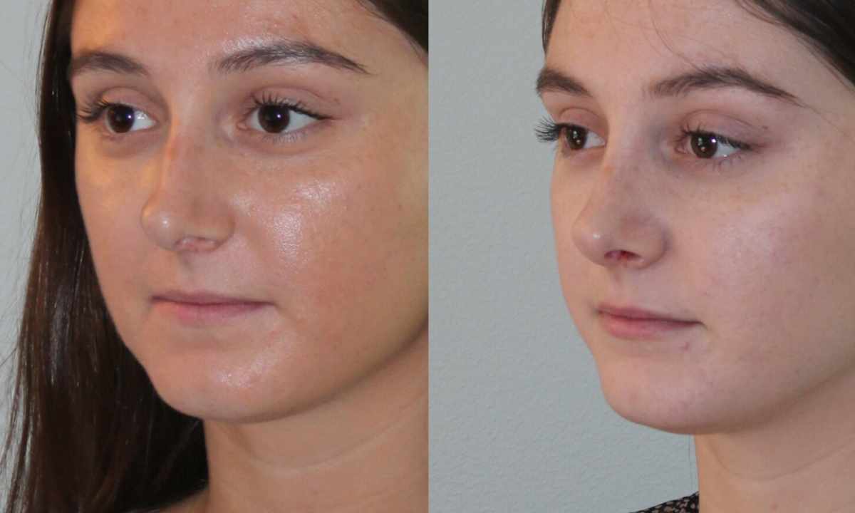 Plastic surgery: reduction of tip of nose