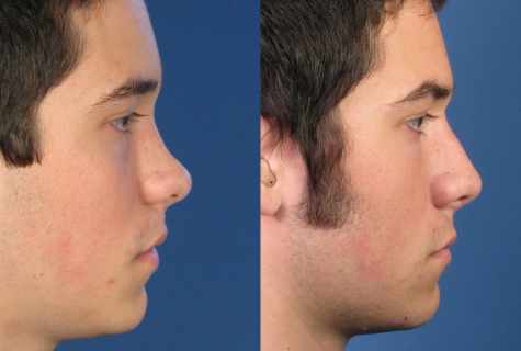 As it is possible to fix nose
