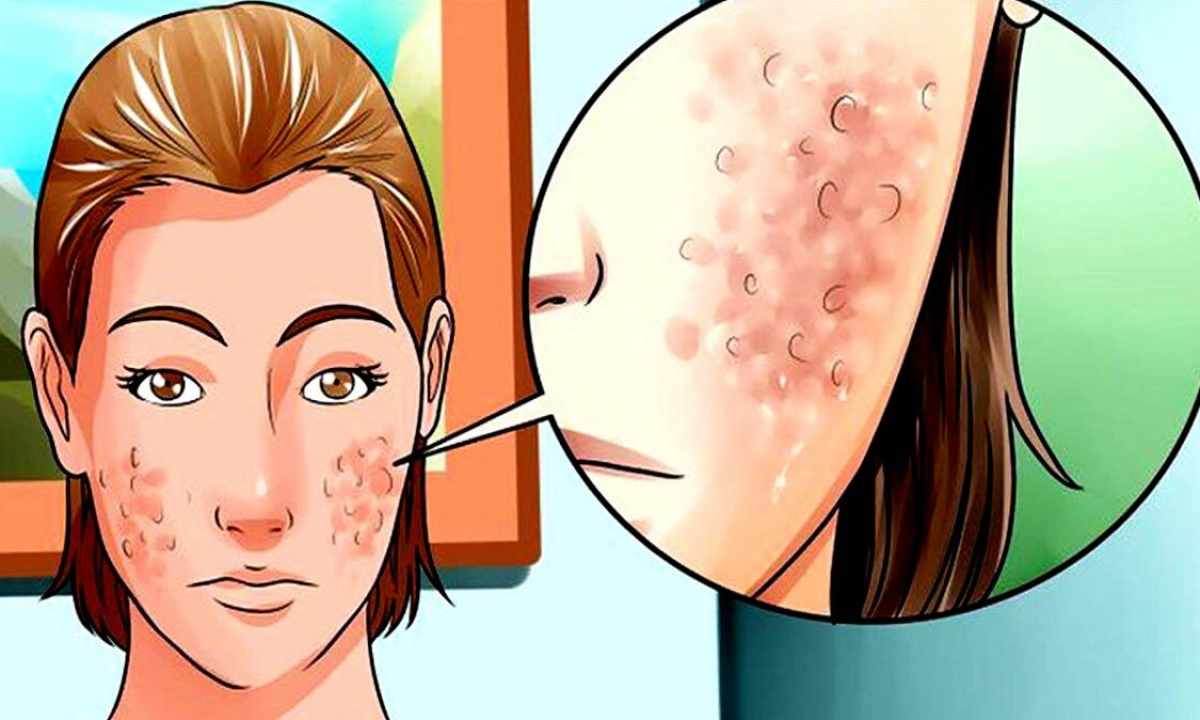 How to remove scars from face