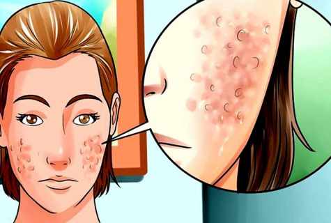 How to remove scar on face