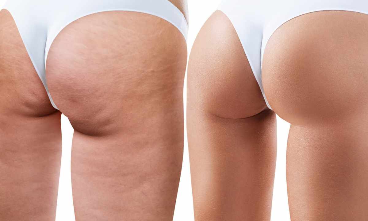 How to remove cellulitis from buttocks